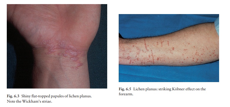 Lichen Planus