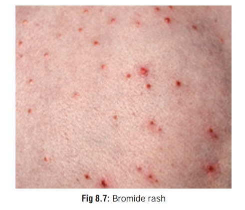 Bromine Chemical Poisons