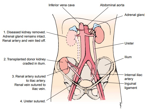 Signs of kidney transplant rejection ati