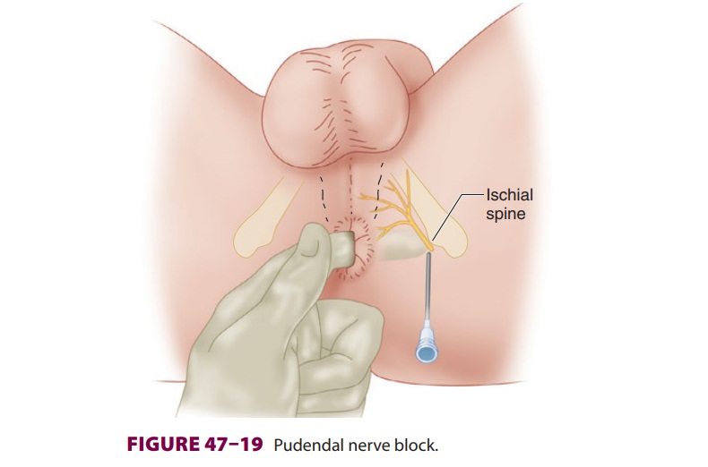 Pudendal Nerve Block